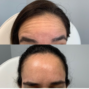 Neuromodulator-Jeuveau