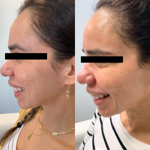 Neuromodulator-Jeuveau