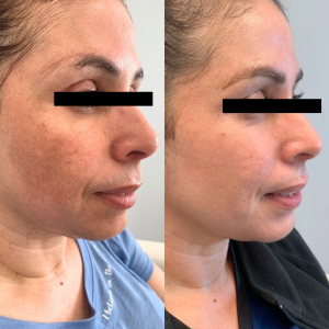 Microneedling