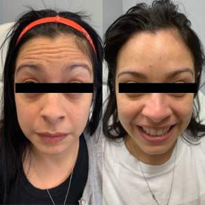 Neuromodulator-Botox