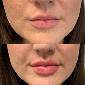 Lip-Filler