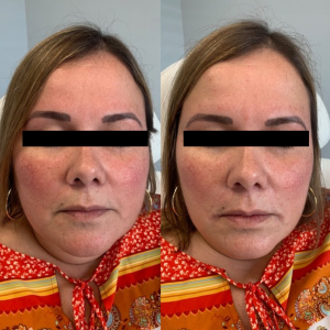 Dermal-filler-marionette-lines