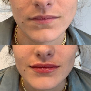 lip-filler